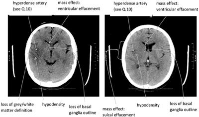 Developing an Integrated Image Bank and Metadata for Large-scale Research in Cerebrovascular Disease: Our Experience from the Stroke Image Bank Project